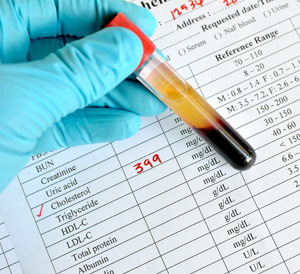 High Cholesterol on a Keto Diet - Should You Be Concerned?